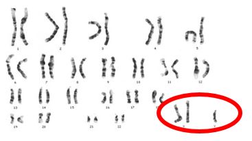 <b>Caryotype d’une personne atteinte du syndrome de Klinefelter</b><div><i>ADN du syndrome de Klinefelter XXY.jpg, par Le chat ~ commonswiki, via Wikimedia commons, CC-BY-SA-3.0-migré,
 https://commons.wikimedia.org/wiki/File:Klinefelter%27s_Syndrome_XXY_DNA.jpg</i><b><br></b></div>