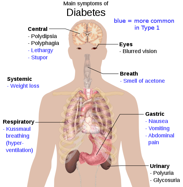 <b>Symptômes du diabète</b><div><i>879px-Main_symptoms_of_diabetes.svg, par Mikael Häggström via Wikimédia Commons, domaine publique, https://commons.wikimedia.org/wiki/File:Main_symptoms_of_diabetes.svg</i><b><br></b></div>