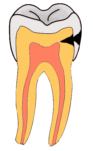 <b>Prémolaire atteinte d’une carie</b><br><i>Source : Smooth Surface Caries GIF.gif par ADuran via wikimedia commons,  CC-BY-SA-3.0-migrated</i>