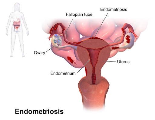 <b>Endométriose<br></b><i>Source : Blausen 0349 Endometriosis.png, par BruceBlaus.  via wikimédia commons, CC-BY-3.0, https://commons.wikimedia.org/wiki/File:Blausen_0349_Endometriosis.png?uselang=fr</i>